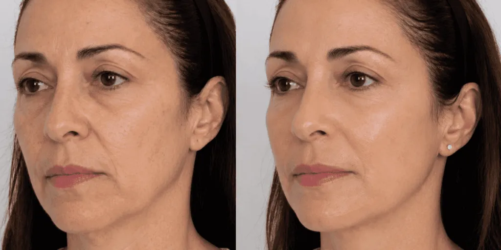 Prima e dopo trattamento viso rassodante con acido polilattico