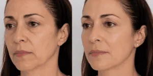 Prima e dopo trattamento viso rassodante con acido polilattico