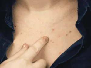 brufoli sul petto cause e sintomi visibili brufoli sul petto uomo con imperfezioni e infiammazioni cutanee