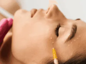 Micro-iniezioni per biorivitalizzazione cutanea del viso con ago sottile in medicina estetica