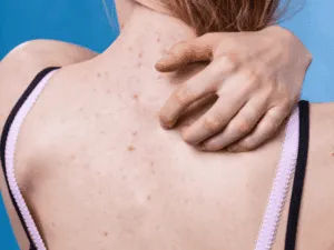Brufoli sulla schiena con prurito e irritazione