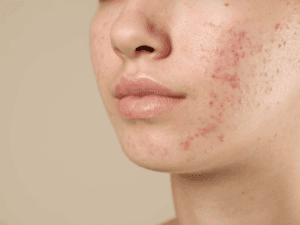 Viso con acne e brufoli infiammati sulla guancia prima di un trattamento di pulizia del viso