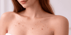 Acne sul petto con piccoli brufoli e imperfezioni cutanee