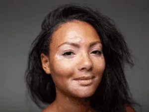 Camouflage per vitiligine – Armonizzazione estetica delle discromie Donna con discromie cutanee che sorride, immagine per servizi di camouflage vitiligine e dermopigmentazione.