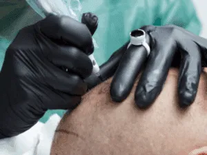 Tricopigmentazione professionale per ricostruzione dell’attaccatura Operatore che effettua un tatuaggio capelli tramite tricopigmentazione con dermografo, delineando l’attaccatura