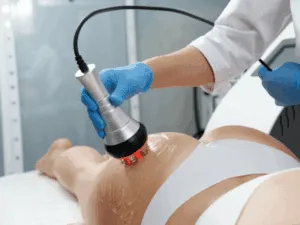 Cavitazione estetica sulle cosce per il trattamento della cellulite con ultrasuoni