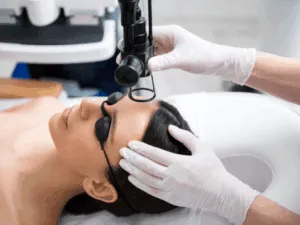 Trattamento laser frazionato CO2 per viso, con dispositivo applicato sulla fronte del paziente.