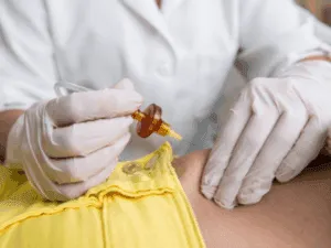 Dettaglio di iniezioni di anidride carbonica con ago sottile e filtro sterile durante una seduta di carbossiterapia corpo.