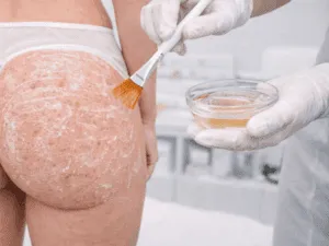 peeling per eliminare brufoli sul sedere Peeling professionale per brufoli sul sedere eseguito con pennello in centro estetico