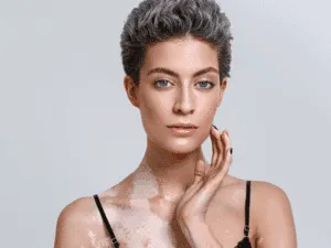 Donna in posa elegante con discromie cutanee, esempio di copertura vitiligine tramite dermopigmentazione.