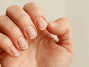 Unghie danneggiate dall’uso scorretto della fresa: segni di sfaldamento e indebolimento della lamina ungueale.