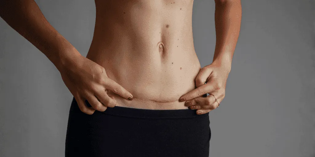 grande cicatrice che necessita di dermopigmentazione medicale e correttiva