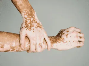 Dermopigmentazione vitiligine su braccia – Esempio di discromie trattabili Braccia con discromie cutanee, utilizzate per mostrare risultati e applicazioni della dermopigmentazione per vitiligine.