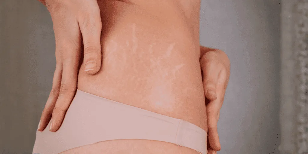 Primo piano di smagliature bianche sulla pelle del fianco di una donna che si tocca la zona con le mani