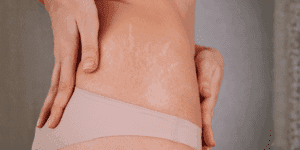 Primo piano di smagliature bianche sulla pelle del fianco di una donna che si tocca la zona con le mani