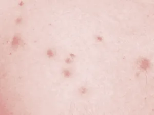 Dettaglio di follicolite sui glutei con pustole e arrossamenti diffusi. Brufoli rossi sul sedere causati da follicolite e infiammazione dei follicoli piliferi