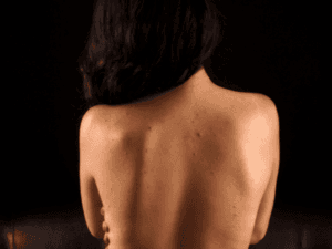 Acne sulla schiena diffusa senza trattamento