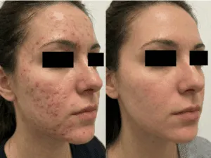 Immagine che mostra i risultati prima e dopo il trattamento laser per acne su viso di donna