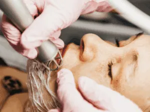 Applicazione laser CO2 per miglioramento cutaneo Trattamento con laser frazionato CO2 su zona del viso, con l'operatore che utilizza il dispositivo su pelle.