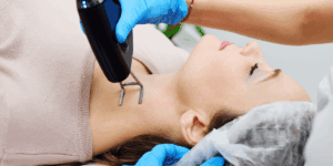 trattamento laser frazionato CO2 su viso donna