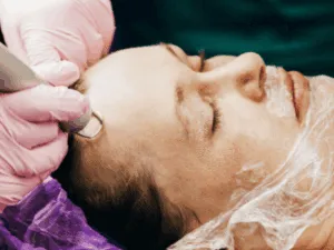 Trattamento del viso con laser CO2 frazionato per ridurre cicatrici e migliorare l'elasticità della pelle.