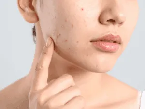 Donna con acne che indica la zona del viso da trattare con laser.