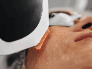 Trattamento laser per cicatrici da acne su viso di donna durante la sessione.