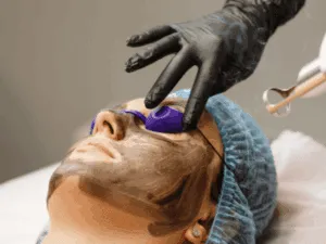 Laser in uso sul viso di una paziente per trattare le macchie cutanee.