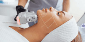 ragazza fa lifting hifu in centro specializzato