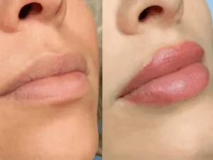 Risultato prima e dopo trattamento di lip blushing con labbra naturali a sinistra e labbra pigmentate e definite a destra.