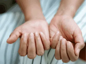 Mani con unghie fragili, sfaldate e secche che mostrano danni da gel o semipermanente