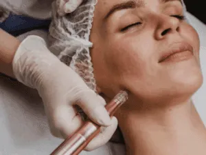 Micro needling viso eseguito su guancia con dermapen in ambiente sterile