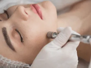 Trattamento di microdermoabrasione viso concentrato sulla zona delle guance per ridurre macchie, pori dilatati e cicatrici leggere.