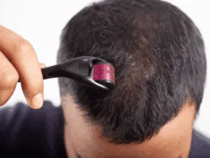 Microneedling capelli per rinforzare i follicoli Microneedling sul cuoio capelluto con dermaroller per contrastare il diradamento dei capell