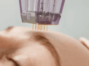 Needling viso con dispositivo a micro-aghi sulla zona della fronte