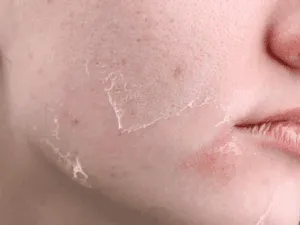 Zona del viso con pelle che sta esfoliando dopo un trattamento di peeling.