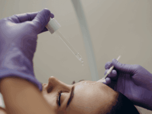 Peeling profondo viso con applicazione di soluzione acida mediante pipetta