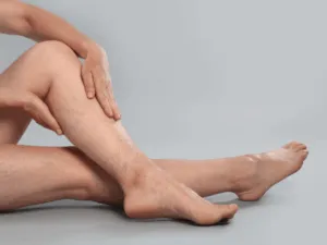 Gambe femminili con vene varicose visibili e problemi al sistema linfatico