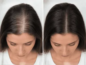 Risultati prp capelli