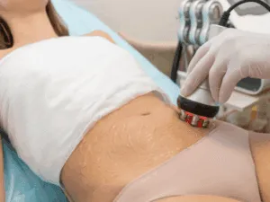Applicazione della radiofrequenza corpo con gel conduttivo sulla zona addominale