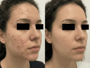 mmagine che mostra il prima e dopo del trattamento laser per acne, evidenziando il miglioramento della pelle.