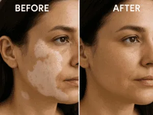 Tatuaggio medicale vitiligine – Prima e dopo la correzione cromatica Confronto prima e dopo di un trattamento di tatuaggio medicale per vitiligine sul viso.