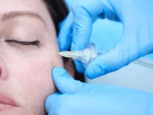 Macro di ago ipodermico per carbossiterapia applicato sulla guancia per stimolare collagene ed elastina.