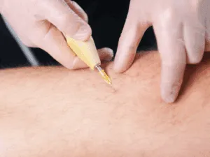 Carbossiterapia per microcircolo gambe Applicazione di carbossiterapia cellulite sulla coscia per riattivare il microcircolo e contrastare la ritenzione idrica.