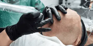 Professionista che esegue una seduta di tricopigmentazione sul cuoio capelluto con strumenti specialistici.