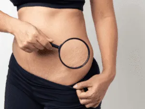 Trattare smagliature bianche – analisi da vicino Donna che osserva le proprie smagliature bianche sull’addome con una lente di ingrandimento