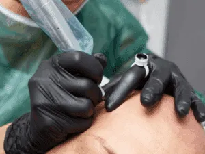 Professionista che applica punti di tricopigmentazione con dermografo per tatuaggio capelli su testa rasata