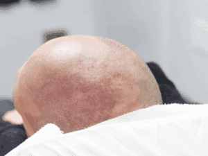Risultato finale della tricopigmentazione su cuoio capelluto Risultato della tricopigmentazione su cuoio capelluto rasato, che simula un tatuaggio capelli per coprire calvizie.