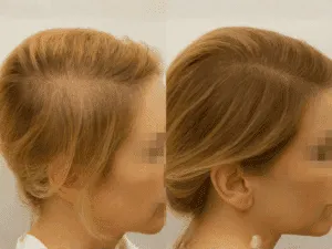 Tricopigmentazione capelli donne – prima e dopo del trattamento Confronto tricopigmentazione prima e dopo su donna, trattamento per tricopigmentazione capelli donne per coprire diradamento.