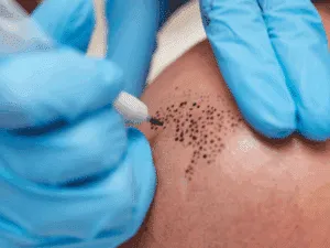 Tricopigmentazione con dermografo per tatuaggio capelli su cuoio capelluto Operatore che utilizza un dermografo per tricopigmentazione per realizzare un tatuaggio capelli su cuoio capelluto rasato, tecnica usata per coprire calvizie.